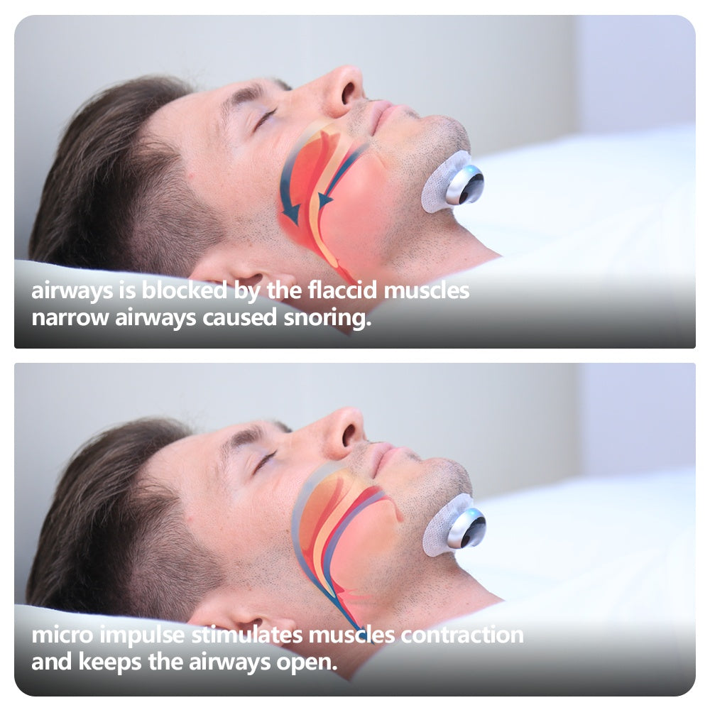 Smart Anti Snoring Device – Effective Sleep Aid